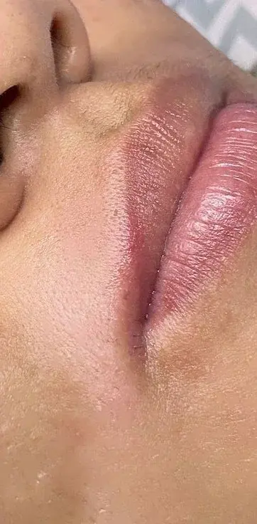 Comparación de un bigote antes y después de la depilación: después